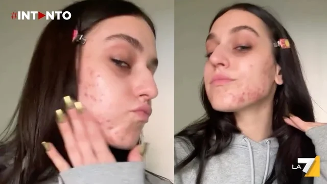 Gaia "senza filtri", si mostra con l’acne sui social: "Quando il corpo chiama, devo ascoltarlo"