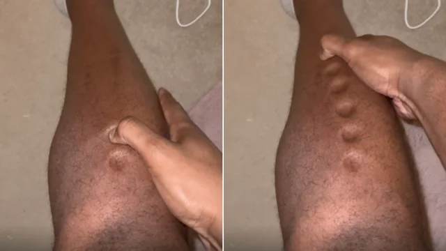 Il campione britannico scopre la malattia su TikTok: "Pelle come plastilina"