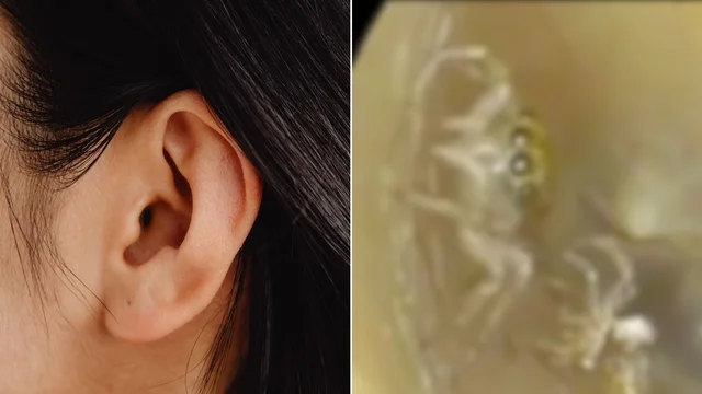 Donna scopre di avere un ragno vivo nell'orecchio e va in panico: video